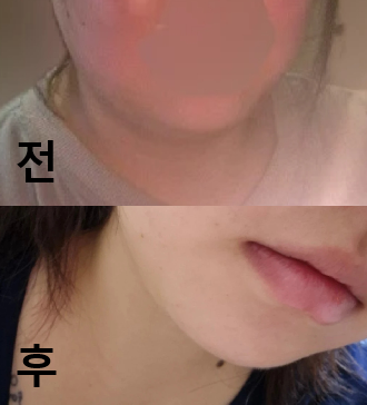 아픔없구 효과직빵 넘좋아용