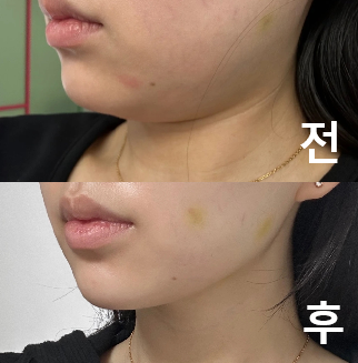 삼일만 지나도 효과가 바로 눈에 보임 개쩐다