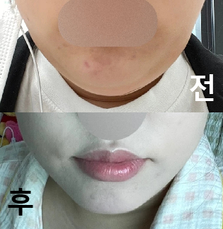 꼼꼼히 시술 해주시고 효과도 좋아요!