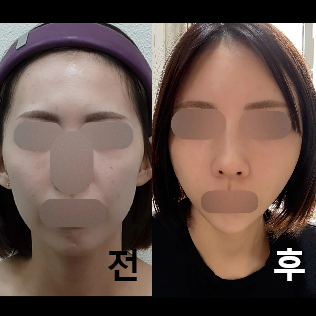 시술 중 통증은 있지만, 옆에서 손을 잡아주거나 격려해줘서 안심하고 받을 수 있었다!