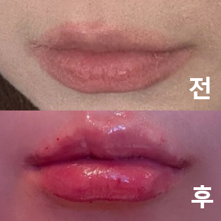 상담 후 저에게 맞는 시술로 진행 했더니 너무 민족스럽습니다!