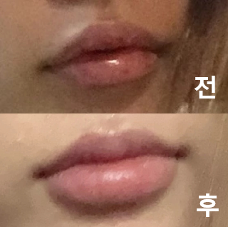 입술 필러는 여기서만 맞습니다