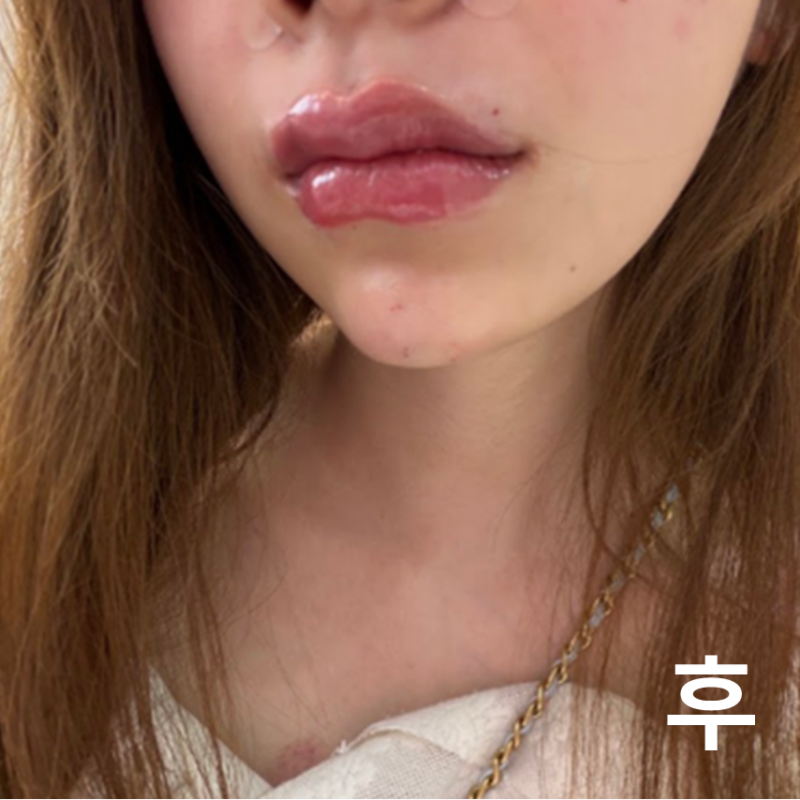 첫필러! 경과가 아주 기대됩니다!