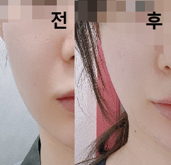 팔자 주름도 옅어지고 얼굴도 작아졌어요!