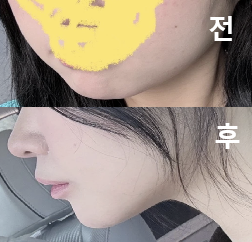 포키주사로 유명해서 속는 셈 치고 맞아 봤는데 너무 좋았어요!