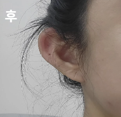 원하는 스타일, 어울리는 스타일대로 정확히 판단해서 시술해 주셨어요!