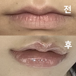 앞으로도 여기서 입술 필러 꾸준히 맞을 것 같아요!