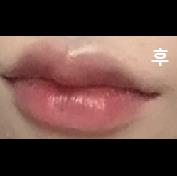 의사선생님께서 제가 원하는 대로 시술 해 주셨어요!