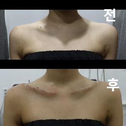 어깨 주변이 여리여리 해졌어요!