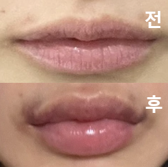 계속 거울로 체크하면서 원하는 모양으로 시술 해주셨어요!