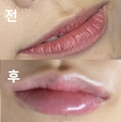 시술이 만족스럽게 돼서 기분이 너무 좋아요!