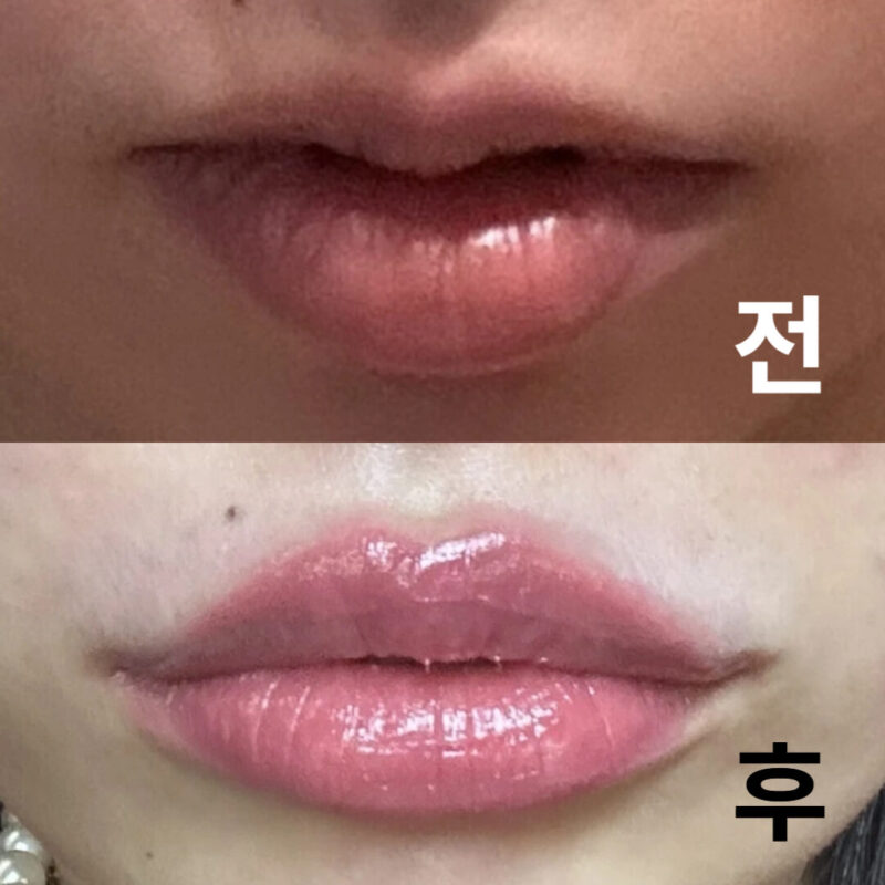 붓기도 거의 없이 금방 귀여운 입술이 되었습니다.