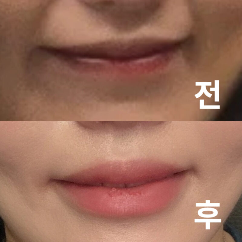 시술 해주시는 의사 선생님이 정말 꼼꼼히 상담 시 체크했던 서류를 실제로 보시며 디자인해주셨어요.