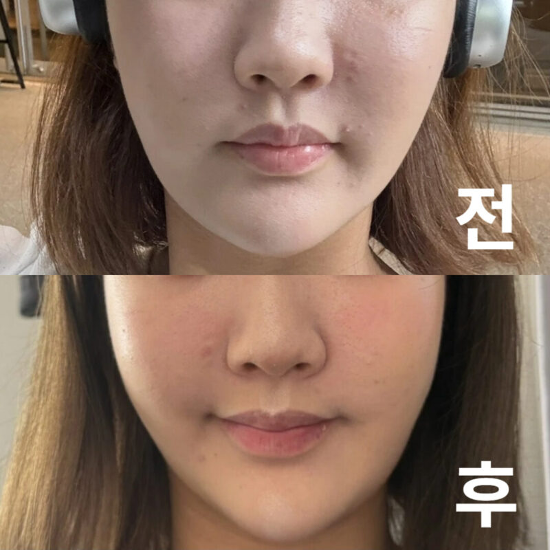 롤리팝은 너무 좋아서 한국에 오면 무조건 매번 꼭 가는 클리닉입니다!