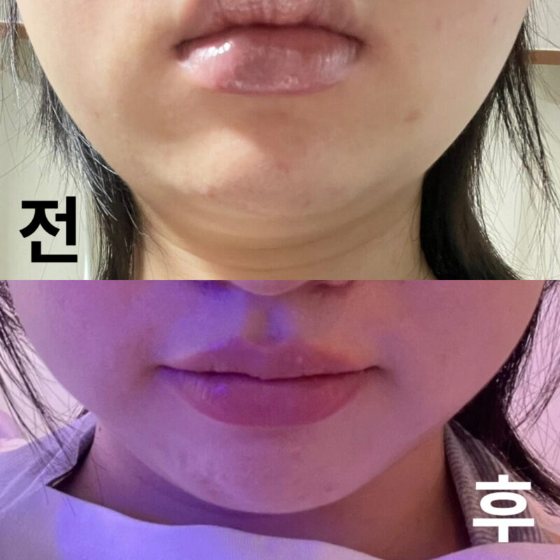 친절하고 시술 하기 전에 고민인 부분에 맞춰서 시술해주시고 불편한 점 없는지 체크하면서 해주셔서 좋았어요