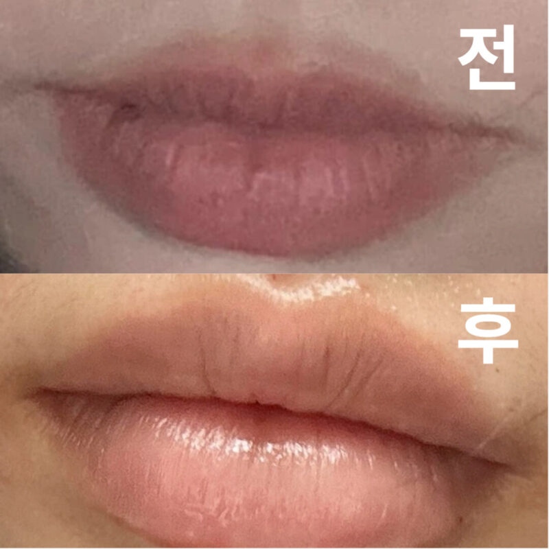 꼼꼼히 시술해주셨고 계속 거울보면서 확인시켜주셔서 너무 좋았습니당