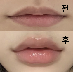 첫 입술 필러인데 너무 만족스럽게 나와서 행복해요!