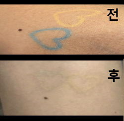 1회 받았는데 눈에 띄게 지워졌어요!