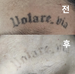 바로 일상생활 가능했어요!