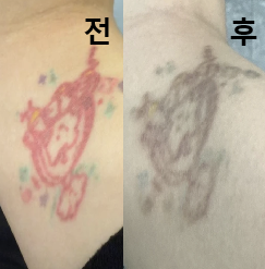 문신 지우기 시작한 이후로 계속 여기서만 지워요!