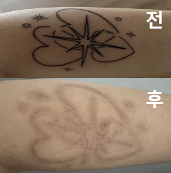 꼼꼼하게 시술 해 주셨어요!