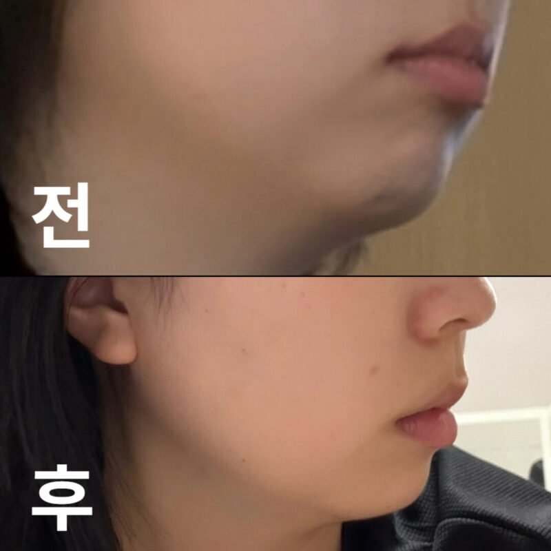 의사선생님도 굉장히 친절하시고 멍 안들게 잘 놔주셔서 좋았습니당