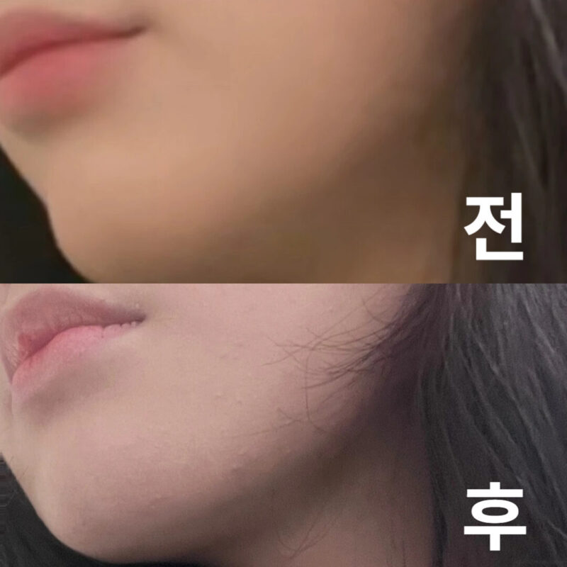 당일날부터 효과가 확실하게 보였고 엄청 만족해요!