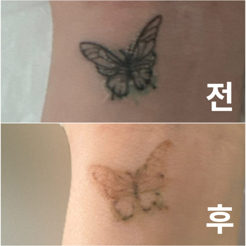 꼼꼼하고 시술 후 드레싱과 집에서 케어할 수 있는 파우치를 주십니다