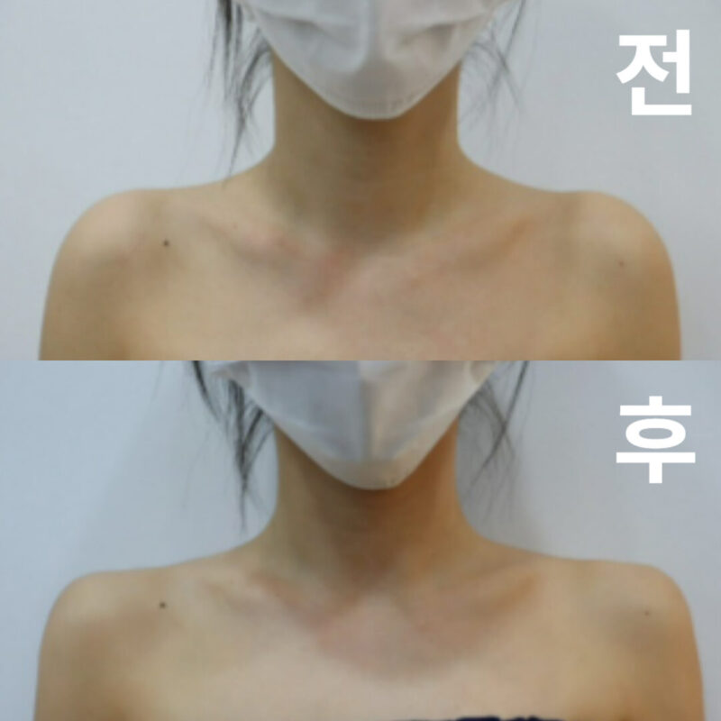 여태까지 했던 필러 중 젤 만족하고 나왔어용