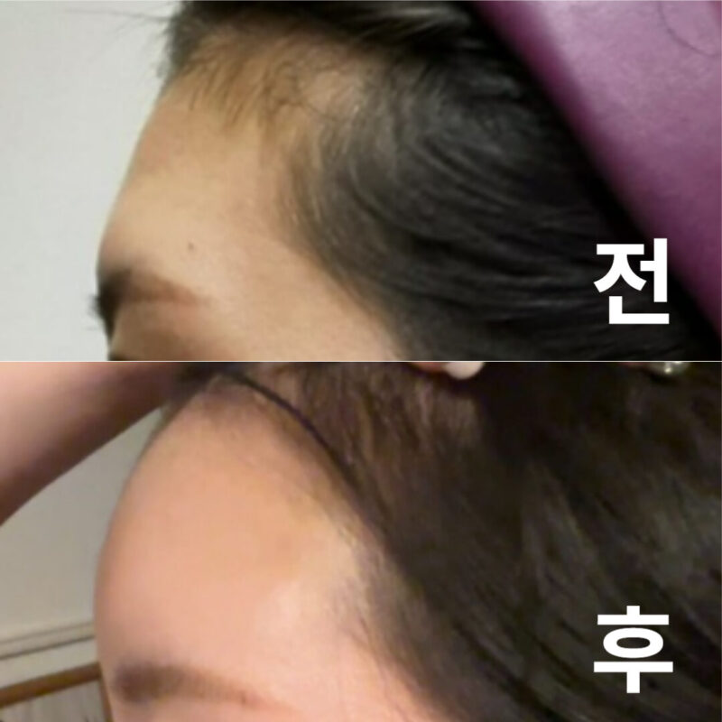 사술 직후부터 굉장히 깔끔한 마무리였어요!