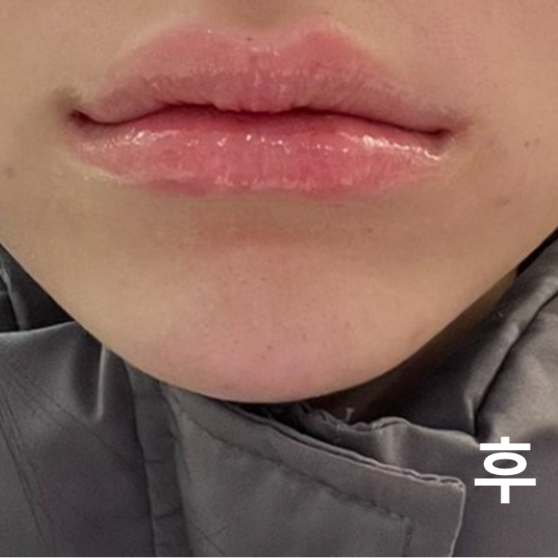 부드럽고 세심한 시술에 감동 받았어요 ㅠ 감사합니다!