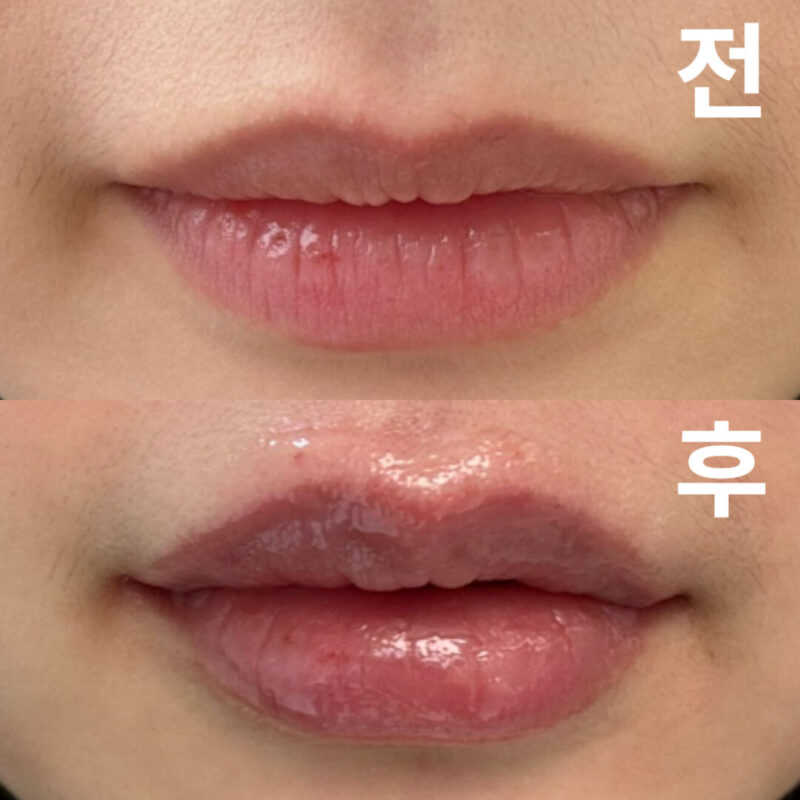 제 입술이 이렇게 될지 정말 몰랐는데 너무 마음에 들어요! 여기로 정착하려구요!