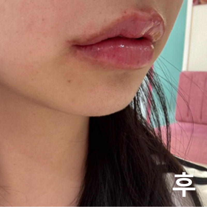 롤리팝 입술필러 너무 예뻐서 대만족... 다음에도 방문할게요~