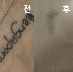 타투가 눈에 띄게 옅어지고 있어서 만족해요!
