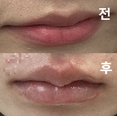 재방문인데 역시나 만족해서 다른 시술하러 또 올 것 같아요!