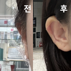 아프지도 않고 눈에 바로 보이는 효과가 좋아요!