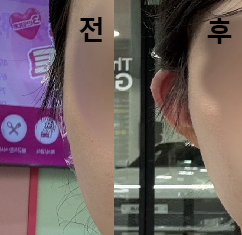 대만족인 시술이었고 금방 끝났어요!