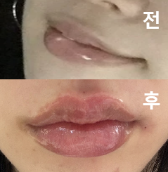 상담도 강요 없이 제게 맞는 시술을 추천해주셨어요!